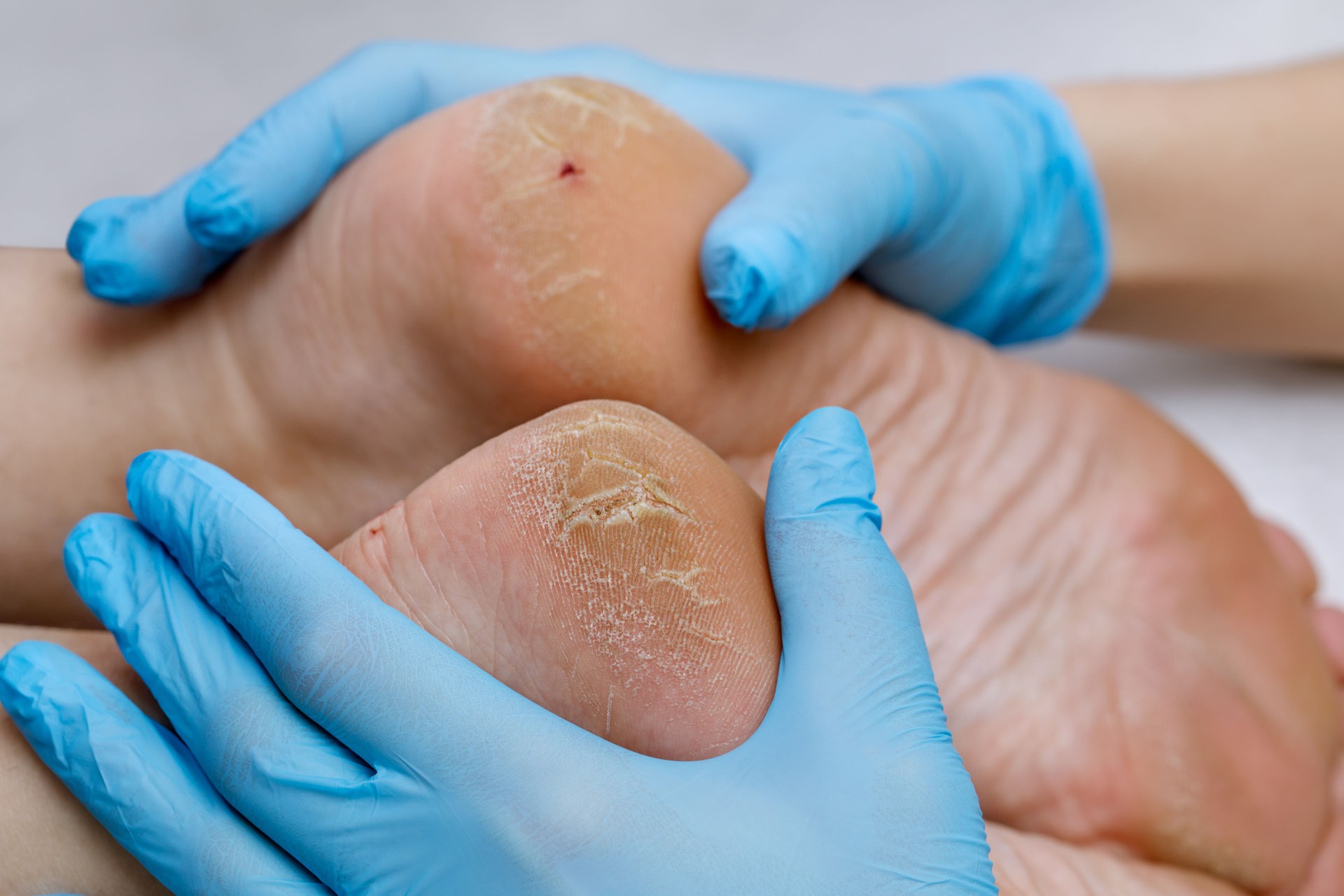 A pedicure doctor examines a patient's feet with problematic heels with cracks and dry skin.